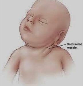 VẸO CỔ BẨM SINH CONGENITAL MUSCUAR TORTICOLLIS (CMT)