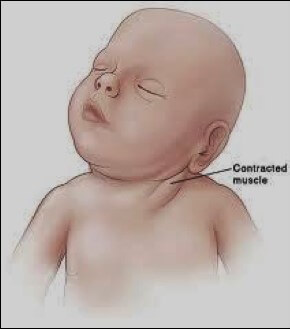 VẸO CỔ BẨM SINH CONGENITAL MUSCUAR TORTICOLLIS (CMT)