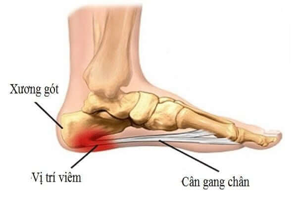 Viêm Gân