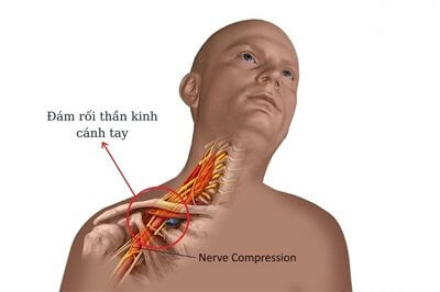 TỔN THƯƠNG ĐÁM RỐI THẦN KINH CÁNH TAY – TRIỆU CHỨNG VÀ CÁCH ĐIỀU TRỊ
