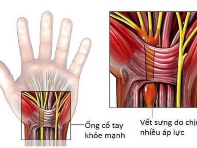 Hội Chứng Ống Cổ Tay