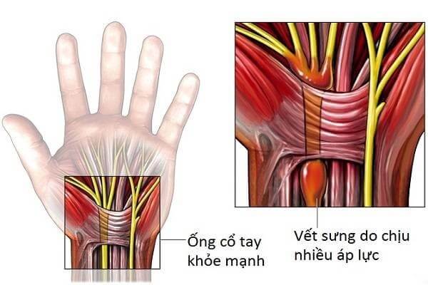 Hội Chứng Ống Cổ Tay