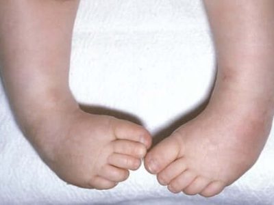 Bàn chân khoèo và các biến dạng của bàn chân