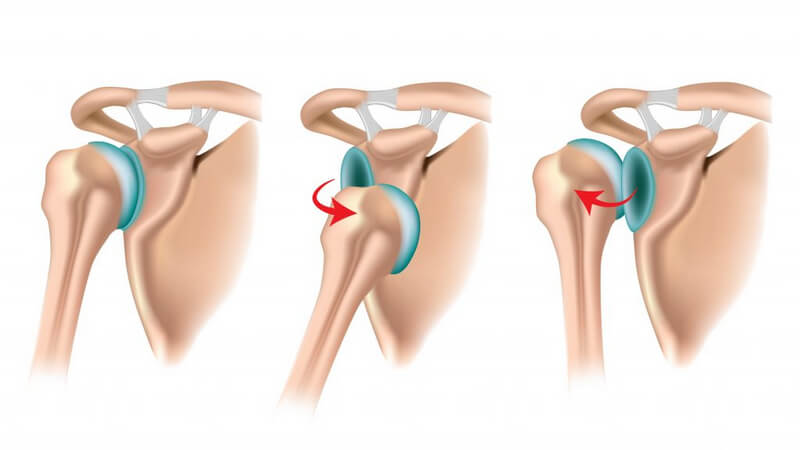 Trật khớp vai