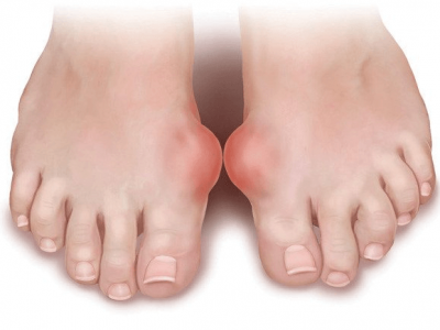Bệnh Gút (Gout) là gì? Nguyên nhân, chẩn đoán và cách điều trị