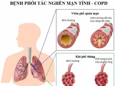BỆNH PHỔI TẮC NGHẼN MÃN TÍNH (COPD)