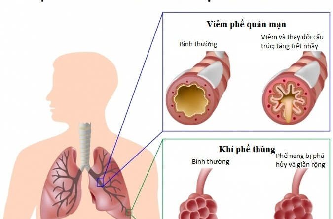 BỆNH PHỔI TẮC NGHẼN MÃN TÍNH (COPD)