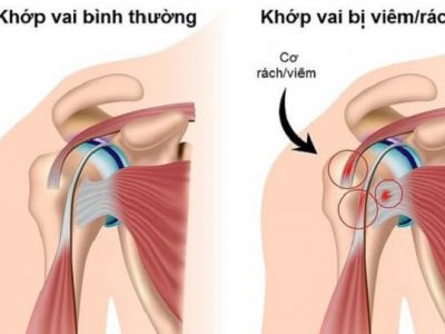 Viêm Chu Vi Vai