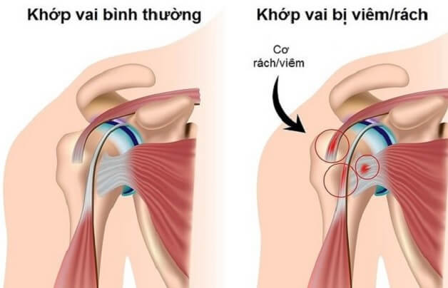 Viêm Chu Vi Vai