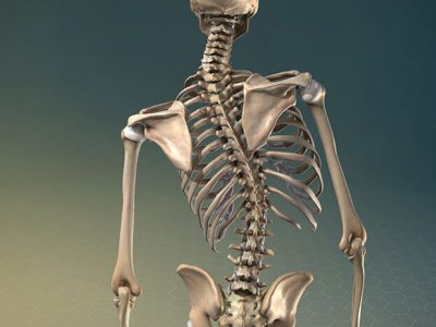 Vẹo cột sống - Nguyên nhân và cách điều trị