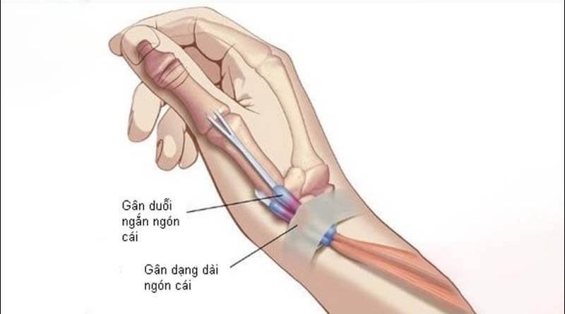 VIÊM GÂN DE QUERVAIN