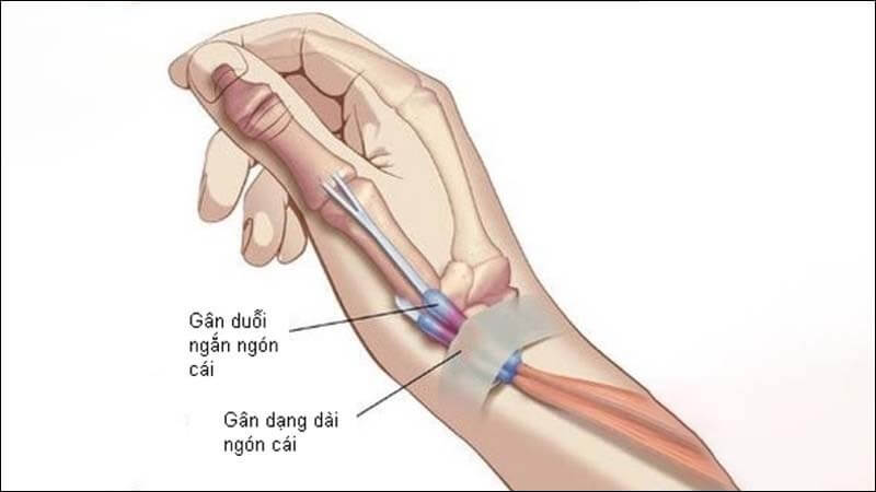 VIÊM GÂN DE QUERVAIN