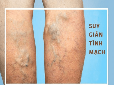 SUY GIÃN TĨNH MẠCH CHÂN - VARICOSE VEINS