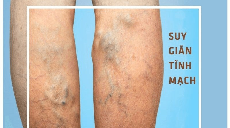 SUY GIÃN TĨNH MẠCH CHÂN - VARICOSE VEINS