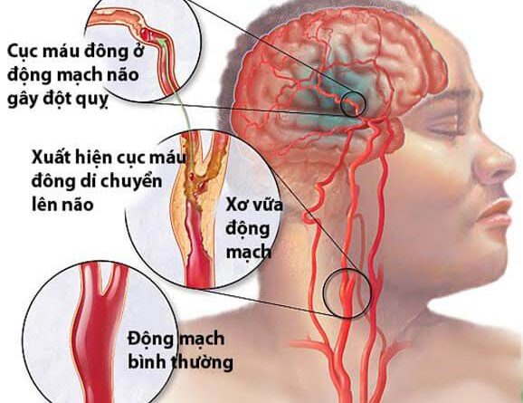 TAI BIẾN MẠCH MÁU NÃO