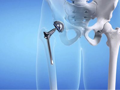 PHỤC HỒI CHỨC NĂNG SAU PHẨU THUẬT THAY KHỚP HÁNG
