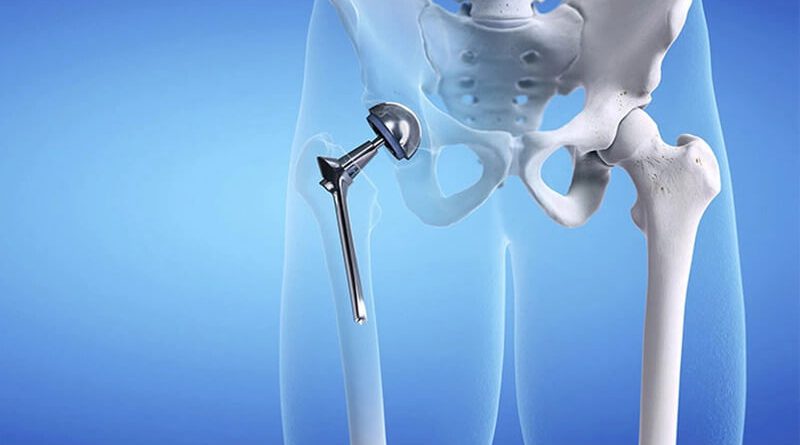 PHỤC HỒI CHỨC NĂNG SAU PHẨU THUẬT THAY KHỚP HÁNG