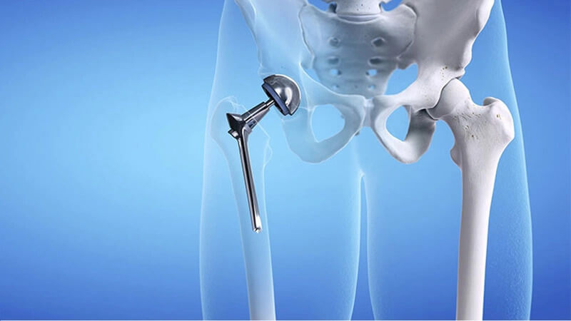 PHỤC HỒI CHỨC NĂNG SAU PHẨU THUẬT THAY KHỚP HÁNG
