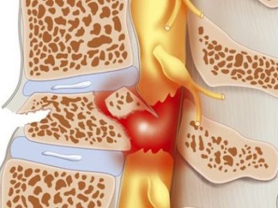 PHỤC HỒI CHỨC NĂNG TỔN THƯƠNG TỦY SỐNG