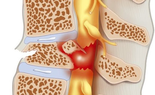 PHỤC HỒI CHỨC NĂNG TỔN THƯƠNG TỦY SỐNG
