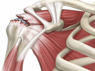 Rách cơ chóp xoay - Vật lý trị liệu - Phục hồi chức năng