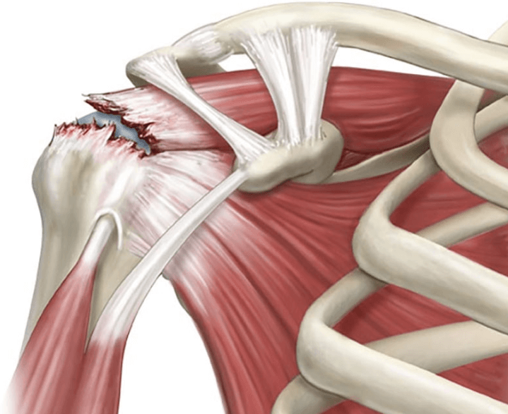Rách cơ chóp xoay - Vật lý trị liệu - Phục hồi chức năng