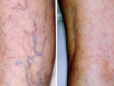 Thuyên tắc huyết khối tĩnh mạch