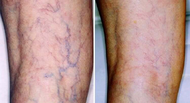 Thuyên tắc huyết khối tĩnh mạch